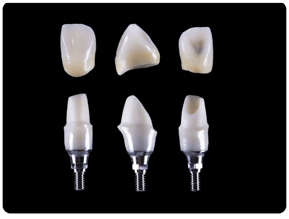 Crowns and Aesthetic Restorations